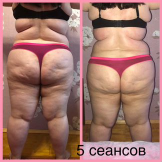 Антицеллюлитный массаж (коррекция фигуры)