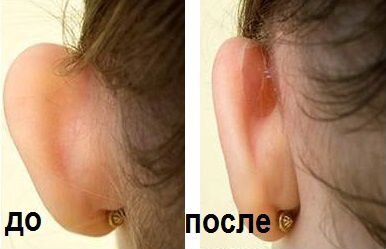 Корректоры для ушей Arilis. Детские